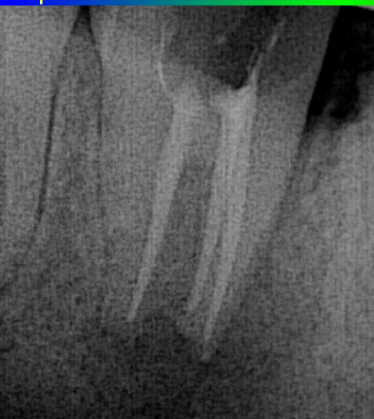 endodontic reatment , root canal treatment